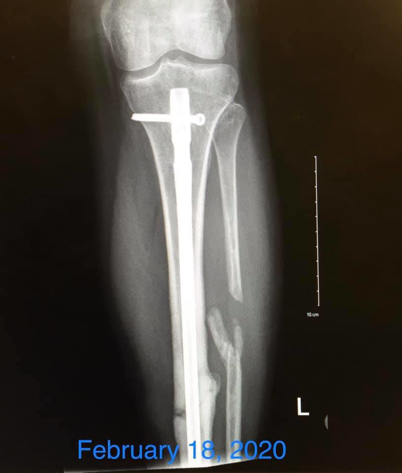 Krista McMurray broken fibula